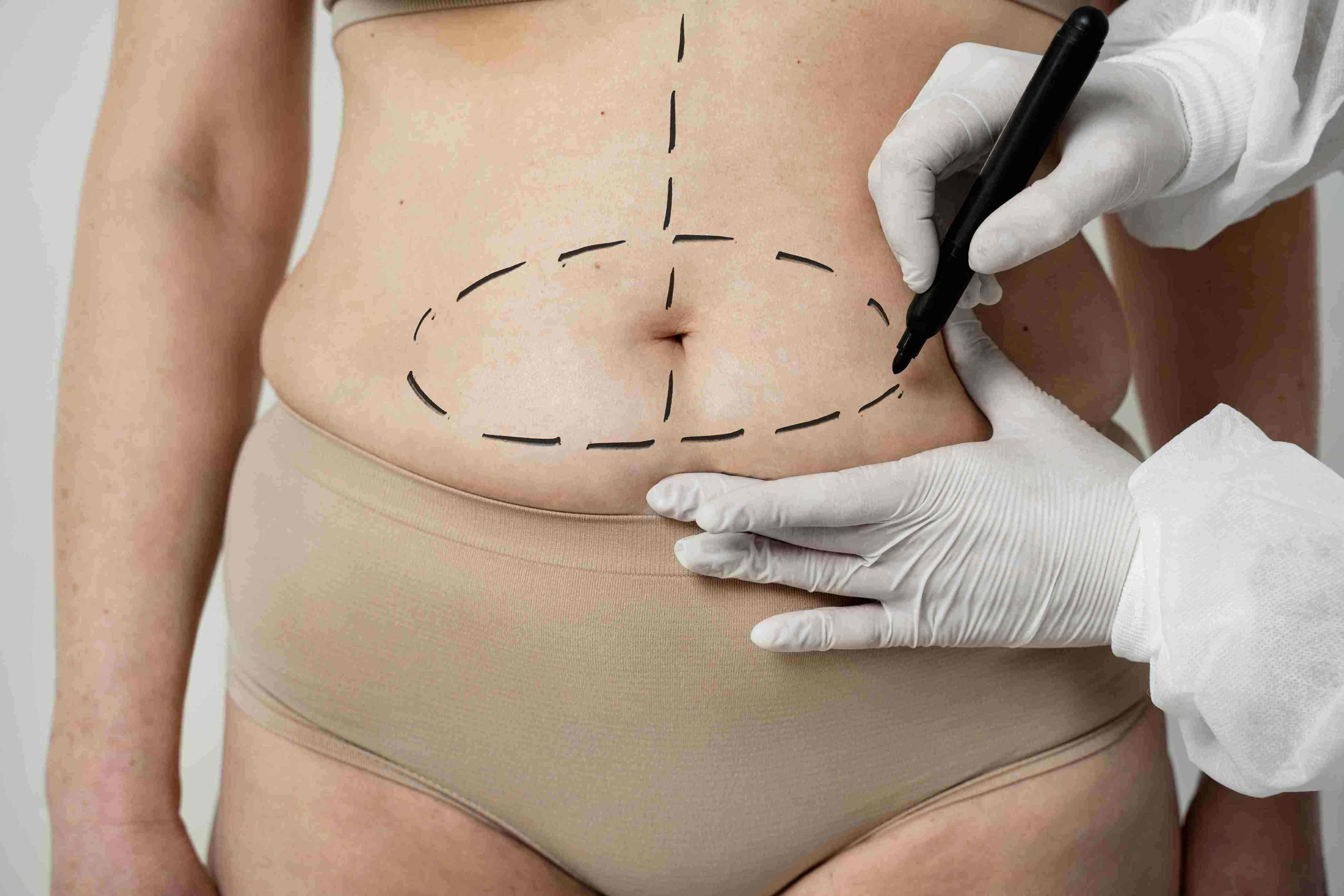 การผ่าตัดหนังหน้าท้อง ศัลยกรรมตัดดึงหนังหน้าท้อง Tummy Tuck